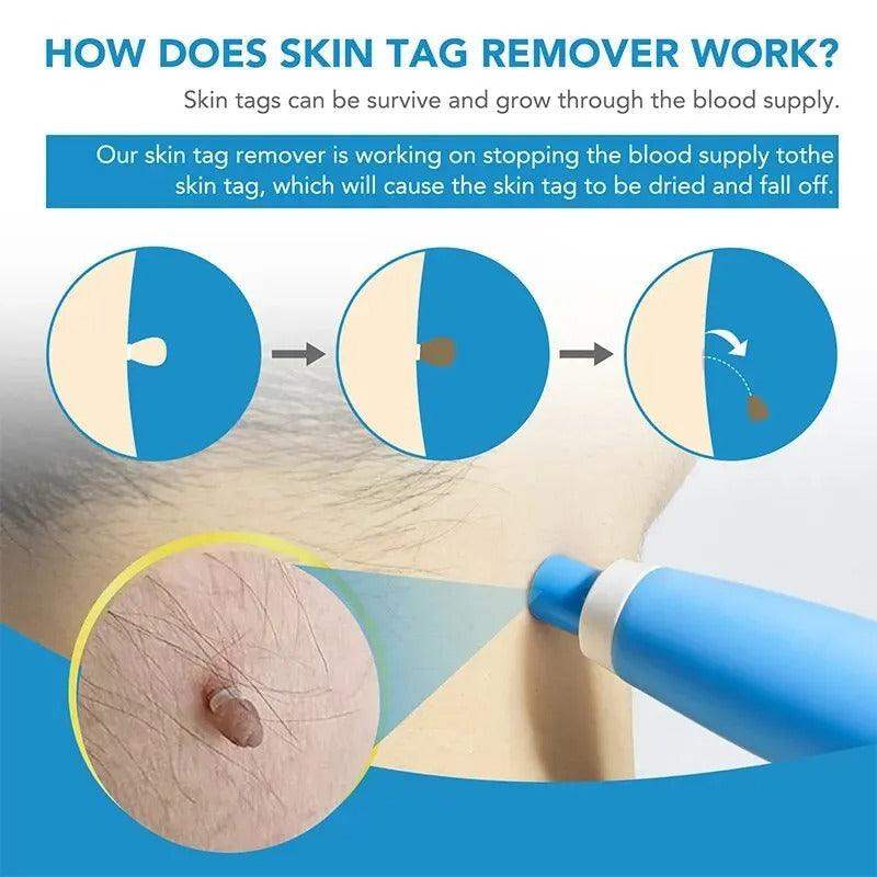 Skin Tag Removal Kit