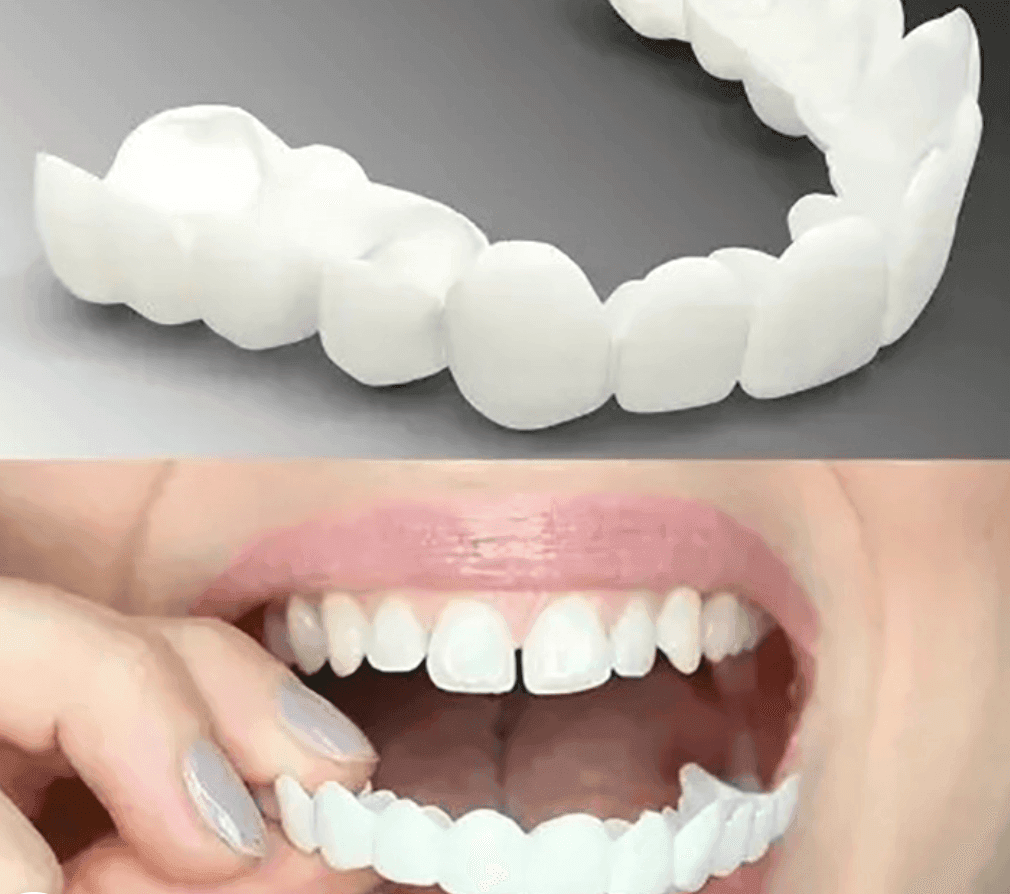 Adjustable Snap-On Dentures