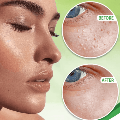 Eye Milia Removal Cream