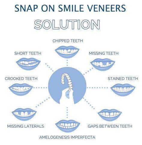 Smile Veneer (Upper & Lower Included)